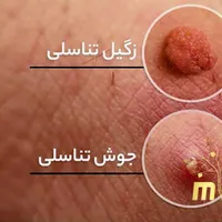 زگیل تناسلی رو‌بدون درد و بدون خطر درمان کن