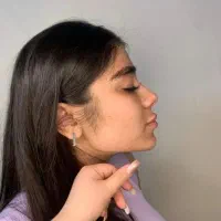 تزریق فیلر لب متد mمادلینگ صورت پی ار پی توسط پزشک
