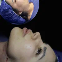 ساکشن سوپر کانتور صورت بلفارو بوکال تزریق چربی|خدمات آرایشگری و زیبایی|مشهد, ملک‌آباد|دیوار