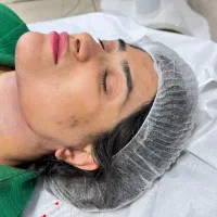 تخلیه چربی غبغب، لیپوفیس