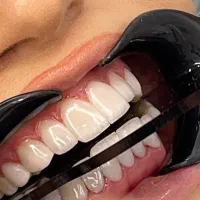 تخفیفات ویژه ونیر کامپوزیت ولمینت برای زیبا جویان