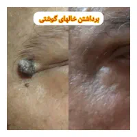 برداشتن خالهای گوشتی و سطحی|خدمات آرایشگری و زیبایی|کرج, عظیمیه|دیوار
