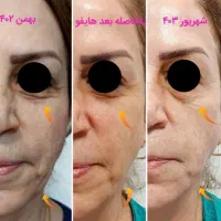 لیزرموزائد سوپرانوتیتانیوم آلما اصلی ۴۹۰تومن|خدمات آرایشگری و زیبایی|گرگان, |دیوار