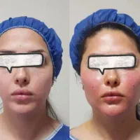 ژل ، بوتاکس ، چربی ، فیلر|خدمات آرایشگری و زیبایی|کرمانشاه, |دیوار