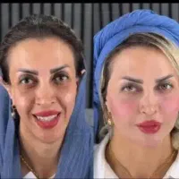 ژل و بوتاکس تضمینی