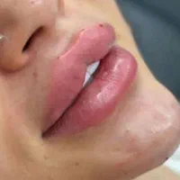 اف ویژه ژل بوتاکس بندرعباس|خدمات آرایشگری و زیبایی|بندرعباس, |دیوار