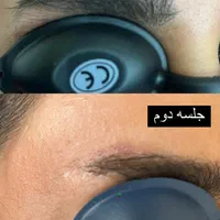 خدمات ریمو تتو،رفع کک و مک کلینک دکتر شریفی|خدمات آرایشگری و زیبایی|فولادشهر, B4|دیوار