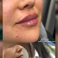 تخفیف بوتاکس و ژل