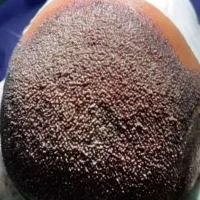 کاشت طبیعی مو ،ابرو،ریش،سیبیل