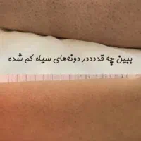 لیزرموزائدتیتانیوم ویژه روز مادر ۵۹۰تومن|خدمات آرایشگری و زیبایی|گرگان, |دیوار