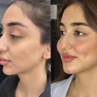 ۵۰ درصد تخفیف فیلر و بوتاکس وجوانساز