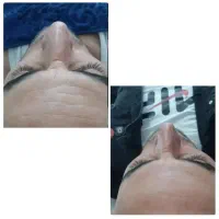 آموزش فیشال و پاکسازی پوست ویژه سال جدید|خدمات آموزشی|خوی, |دیوار