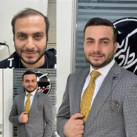 کاشت موی موقت ترمیم مو ۱ روزه آرایشگاه داماد عروسی