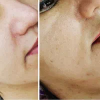 جشنواره یلدایی فشیال و پاکسازی پوست|خدمات آرایشگری و زیبایی|تهران, حکیمیه|دیوار