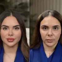 فیلر ژل‌450بوتاکس آنزیم مزو هایفو فشیال وجوانسازی