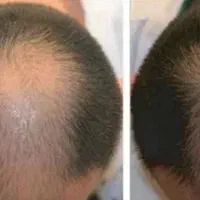 رفع جای جوش ،ریزش مو ،خال برداری برای آقایان|خدمات آرایشگری و زیبایی|خرمشهر, |دیوار