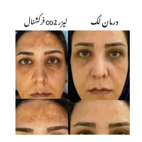 لیزر موهای زائد فول بادی ۴۹۰ تومان|خدمات آرایشگری و زیبایی|رشت, گلسار|دیوار