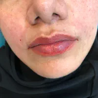 تزریق بوتاکس و ژل