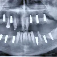 جشنواره زمستانه ایمپلنت با قیمت استثنایی