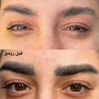 جشنواره‌ تخصصی ریموو تتو با دستگاه فوق‌ پیشرفته|خدمات آرایشگری و زیبایی|دزفول, |دیوار