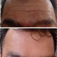 ژل بوتاکس آموزش تخصصی در مطب|خدمات آرایشگری و زیبایی|اصفهان, شهرک کاوه|دیوار