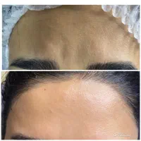 خدمات پاکسازی و فیشال پوست