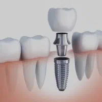 جراحی ایمپلنت دندان کره ای فقط ۱۸ میلیون