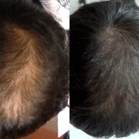 ویژه اقایان آف بوتاکس فیلر و پاکسازی|خدمات آرایشگری و زیبایی|کرج, گلشهر|دیوار