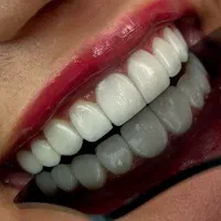 لمینت،کامپوزیت،ایمپلنت با شرایط اقساط