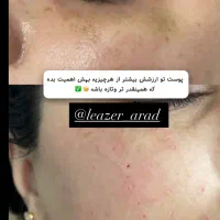 ریمولک تک جلسه ایی|خدمات آرایشگری و زیبایی|سرپل ذهاب, |دیوار