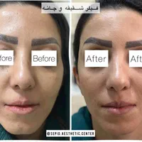 بوتاکس‌ ژل فیلر مزو خالبرداری‌ کرایو‌ وهایفو ولیزر|خدمات آرایشگری و زیبایی|تبریز, |دیوار