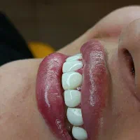 جشنواره کامپوزیت لمینیت عصب IPS IMAX روکش N2 ونیر|خدمات آرایشگری و زیبایی|تهران, هفت حوض|دیوار