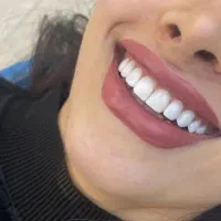 کامپوزیت ۴۰درصد تخفیف|خدمات آرایشگری و زیبایی|خرم‌آباد, |دیوار