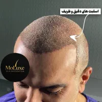 کاشت مو، ریش و ابرو با جدیدترین متد روز دنیا|خدمات آرایشگری و زیبایی|شیراز, عفیف‌آباد|دیوار