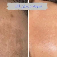 رویش مو (پی ارپی ، مزوتراپی )|خدمات آرایشگری و زیبایی|اهواز, پادادشهر|دیوار