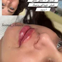 جشنواره بوتاکس و فیلر و همچنین لیفت با نخ