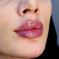 *جشنواره تکرار نشدنی بوتاکس،فیلر و ژل و مزوتراپی*