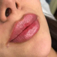 ژل و بوتاکس جوانسازی افسریه