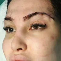 مدل بلفارو پلاستی لیفت ابرو کاشت ابرو سانترال لب