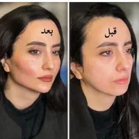 تزریق ژل بوتاکس و ساکشن تزریق چربی درکلینیک|خدمات آرایشگری و زیبایی|کرمانشاه, |دیوار