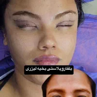 افتادگی پلک،بلفاروپلاستی،سانترال لب،بوکال فت،غبغب