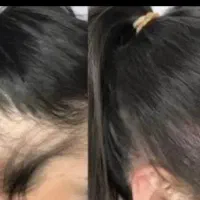 اسکالپ سر رفع کم‌پشتی کف سربرندآمریکای زیرنظرپزشک