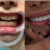 کامپوزیت دندان جشنواره ی تخفیفات تا شب یلدا|خدمات آرایشگری و زیبایی|رشت, معلم|دیوار