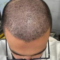 کاشت مو|خدمات آرایشگری و زیبایی|رفسنجان, |دیوار