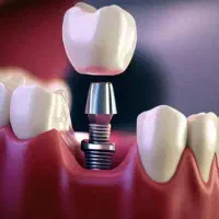 خدمات تخصصی ایمپلنت و اوردنچر