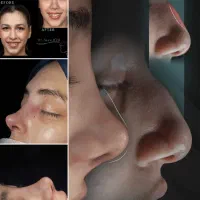 عمل زیبایی بینی