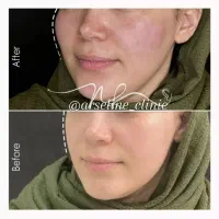 آموزش فیلر،بوتاکس،مزو،مزو ژل با مدرک|خدمات آموزشی|آبادان, |دیوار