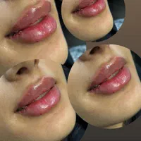 اف فیلرلب گونه چونه زاویه فقط 649|خدمات آرایشگری و زیبایی|محمدیه-قزوین, |دیوار