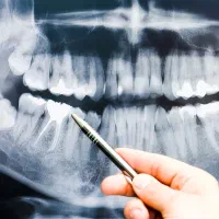 راهنمایی درمان دندان دانشکده ها