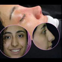 عمل رینوپلاستی و جراحی بینی عمل انحراف بینی|خدمات آرایشگری و زیبایی|اهواز, گلستان|دیوار